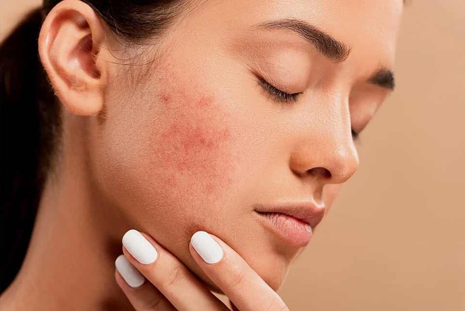 Treatment of Acne Online Patient