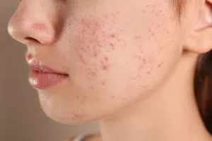 online acne consultation