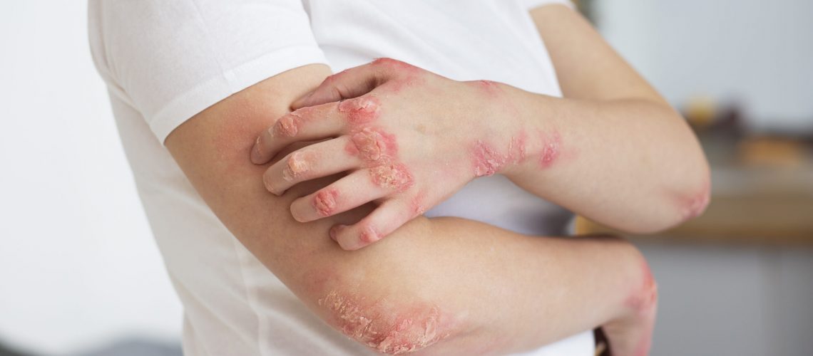 Poison Oak Rashes